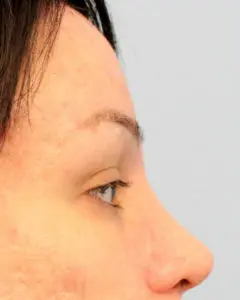 Mardirossian Facial Aesthetics Before and After Pictures