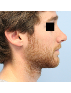 Mardirossian Facial Aesthetics Before and After Pictures