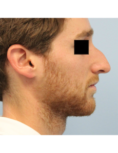 Mardirossian Facial Aesthetics Before and After Pictures