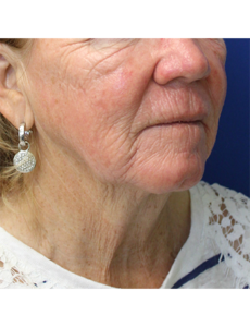 Mardirossian Facial Aesthetics Before and After Pictures