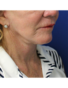 Mardirossian Facial Aesthetics Before and After Pictures