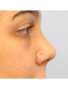 Mardirossian Facial Aesthetics Before and After Pictures