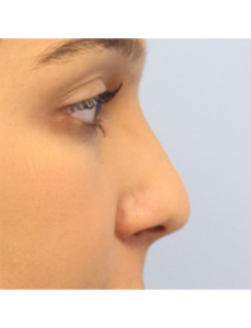 Mardirossian Facial Aesthetics Before and After Pictures