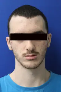 Mardirossian Facial Aesthetics Before and After Pictures