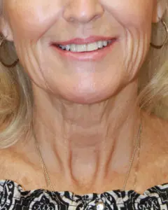 Mardirossian Facial Aesthetics Before and After Pictures