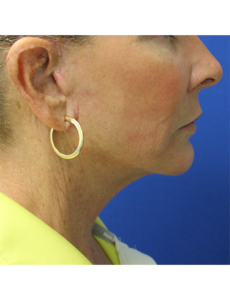 Mardirossian Facial Aesthetics Before and After Pictures