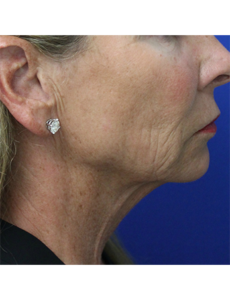 Mardirossian Facial Aesthetics Before and After Pictures