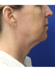 Mardirossian Facial Aesthetics Before and After Pictures