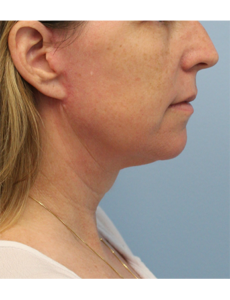 Mardirossian Facial Aesthetics Before and After Pictures