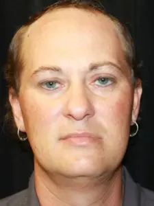 Mardirossian Facial Aesthetics Before and After Pictures