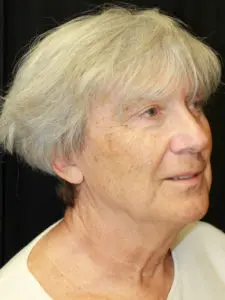 Mardirossian Facial Aesthetics Before and After Pictures