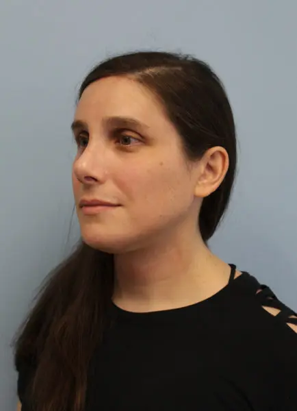 Mardirossian Facial Aesthetics Before and After Pictures
