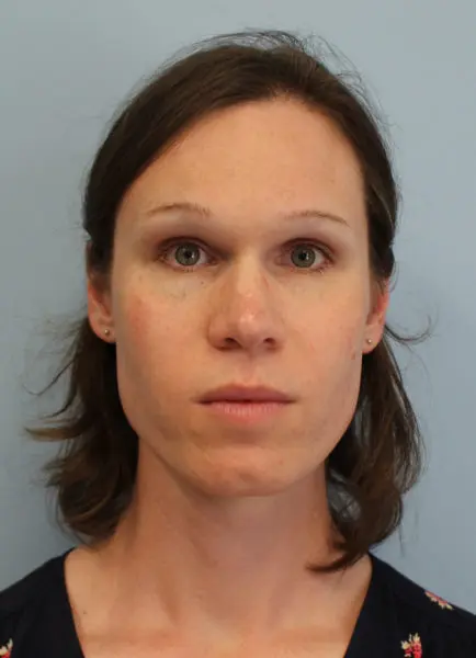 Mardirossian Facial Aesthetics Before and After Pictures