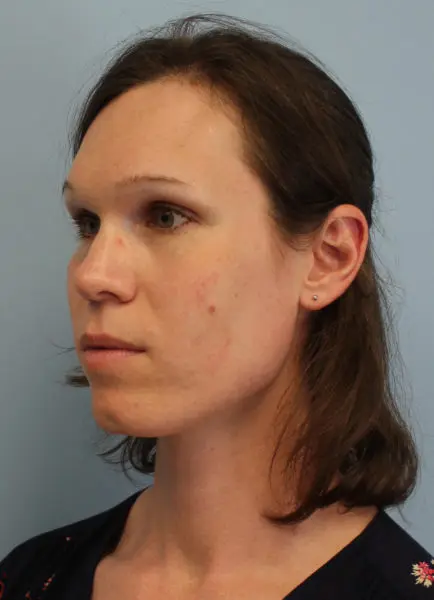 Mardirossian Facial Aesthetics Before and After Pictures