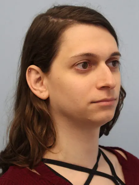Mardirossian Facial Aesthetics Before and After Pictures
