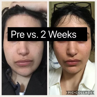 41599962_2635828079764429_6504601568904478720_n Buccal Fat Removal Before and After Pictures McLean, VA