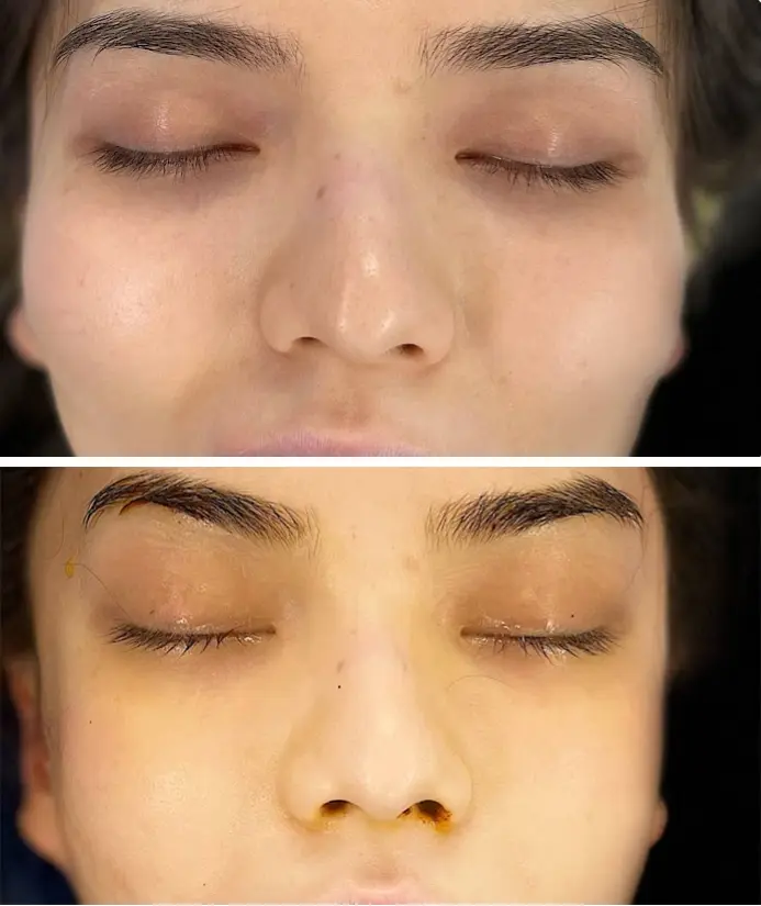 Cheekbone reduction1Combined Cheekbone Reduction Before and After Pictures McLean, VA
