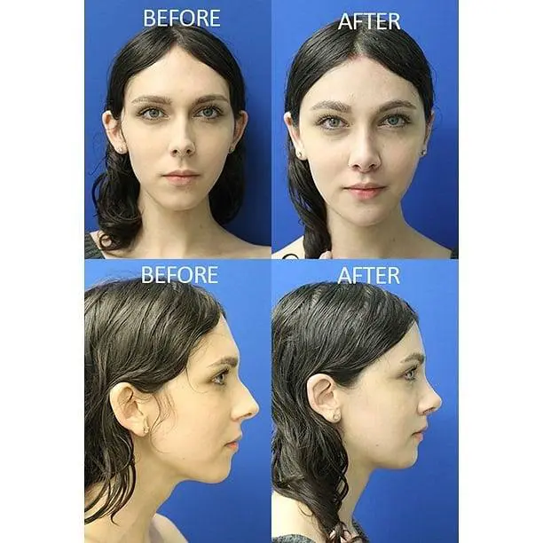 FFS2 Mandible Contouring Before and After Pictures McLean, VA