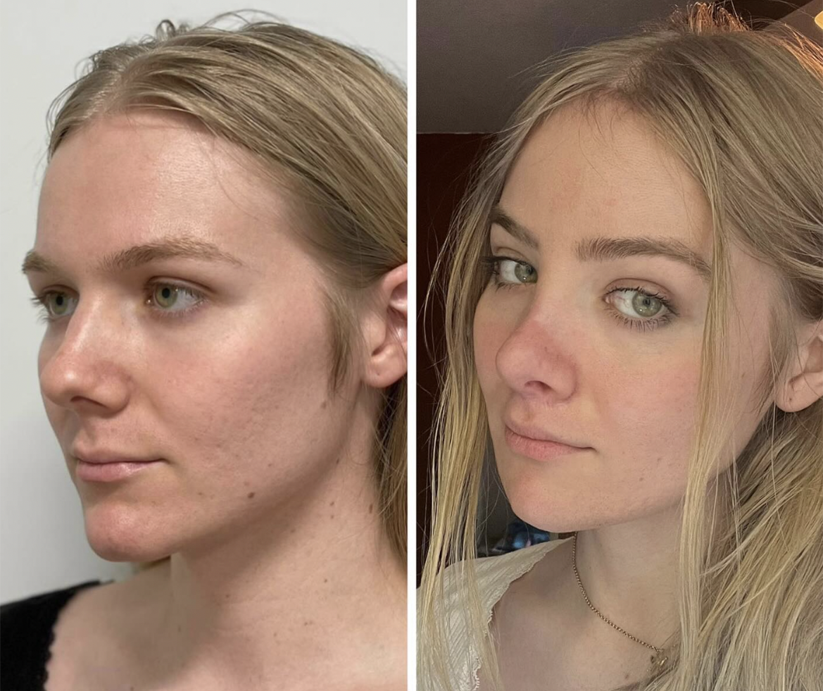 Facial Feminization Surgery (FFS) in McLean, VA