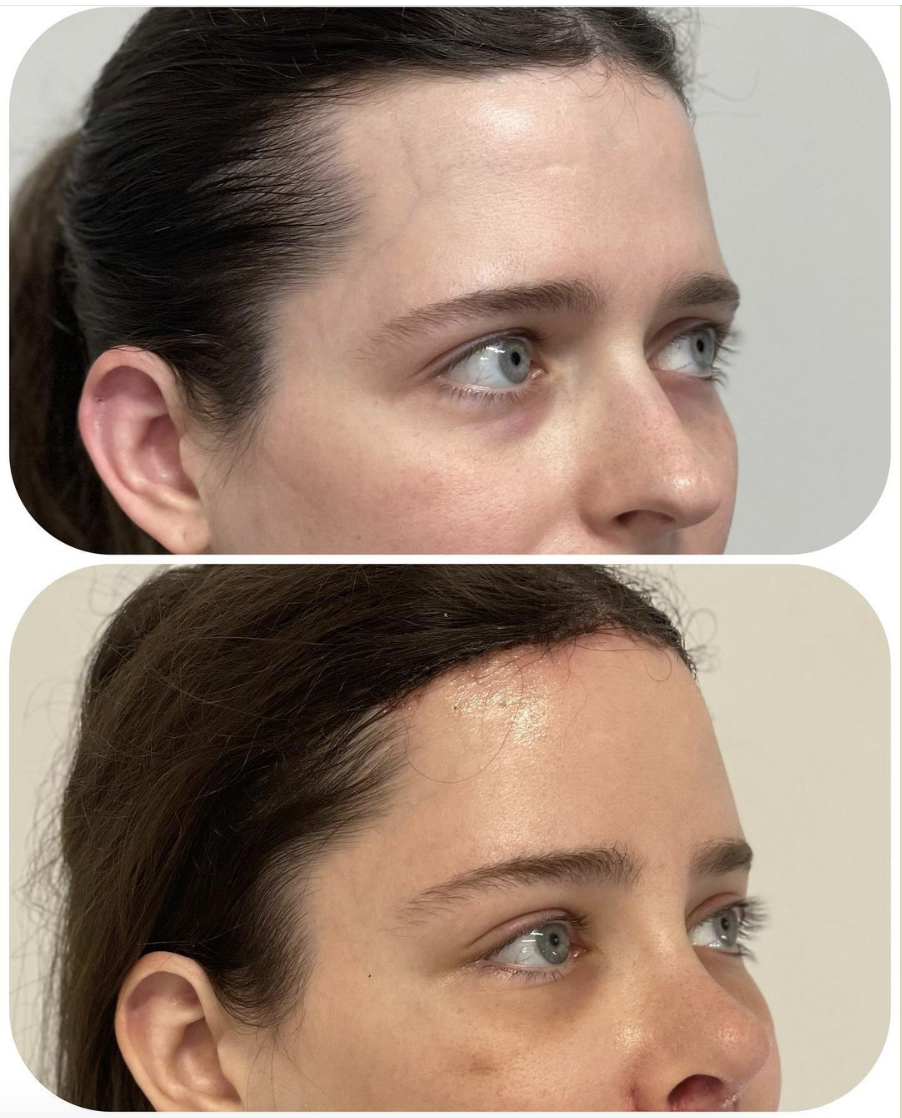 browlift Forehead/Brow Lift in McLean, VA