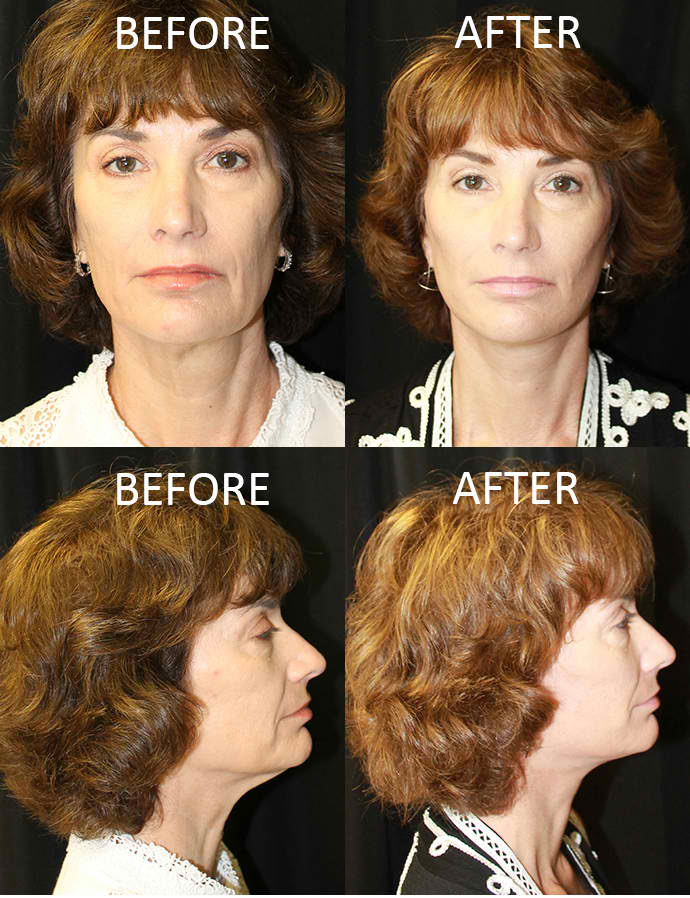 Rhinoplasty