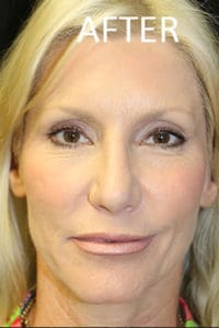 Rhinoplasty Before and After Pictures West Palm Beach, FL