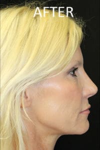 Rhinoplasty Before and After Pictures West Palm Beach, FL