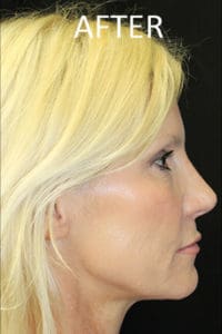 Mardirossian Facial Aesthetics Before and After Pictures