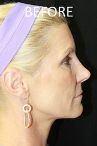 Rhinoplasty Before and After Pictures West Palm Beach, FL