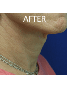 Tracheal Shave Before and After Pictures West Palm Beach, FL