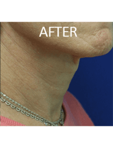 Mardirossian Facial Aesthetics Before and After Pictures