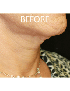 Tracheal Shave Before and After Pictures West Palm Beach, FL