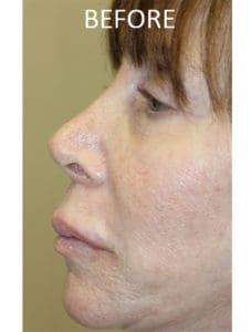 Mardirossian Facial Aesthetics Before and After Pictures