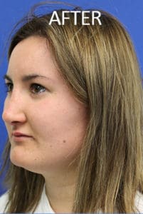 Rhinoplasty Before and After Pictures West Palm Beach, FL