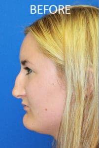 Rhinoplasty Before and After Pictures West Palm Beach, FL