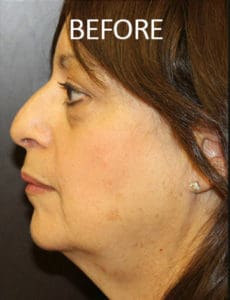 Mardirossian Facial Aesthetics Before and After Pictures