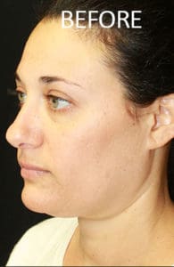 Mardirossian Facial Aesthetics Before and After Pictures