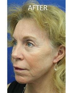 Brow Lift Before and After Pictures West Palm Beach, FL