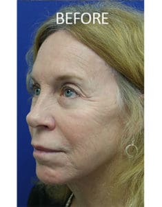 Mardirossian Facial Aesthetics Before and After Pictures