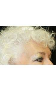 Brow Lift Before and After Pictures West Palm Beach, FL