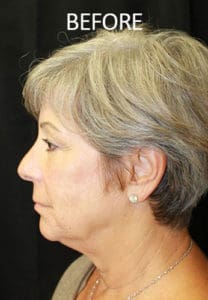Cheek Augmentation Before and After Pictures West Palm Beach, FL