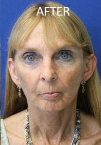 Mardirossian Facial Aesthetics Before and After Pictures