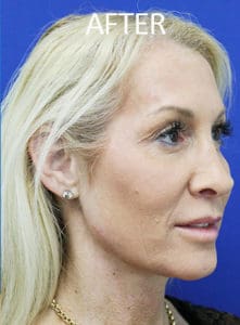 Cheek Augmentation Before and After Pictures West Palm Beach, FL