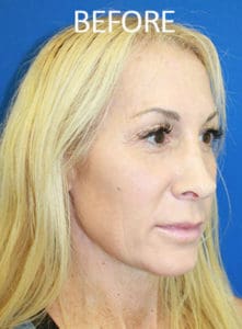 Mardirossian Facial Aesthetics Before and After Pictures