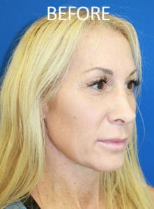 Lip Lift Before and After Pictures West Palm Beach, FL