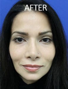 Chin Implants Before and After Pictures West Palm Beach, FL