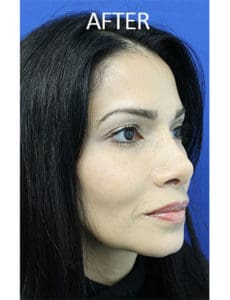 Chin Implants Before and After Pictures West Palm Beach, FL