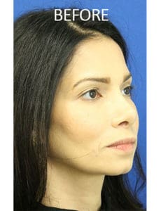 Chin Implants Before and After Pictures West Palm Beach, FL