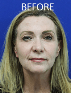 Chin Implants Before and After Pictures West Palm Beach, FL