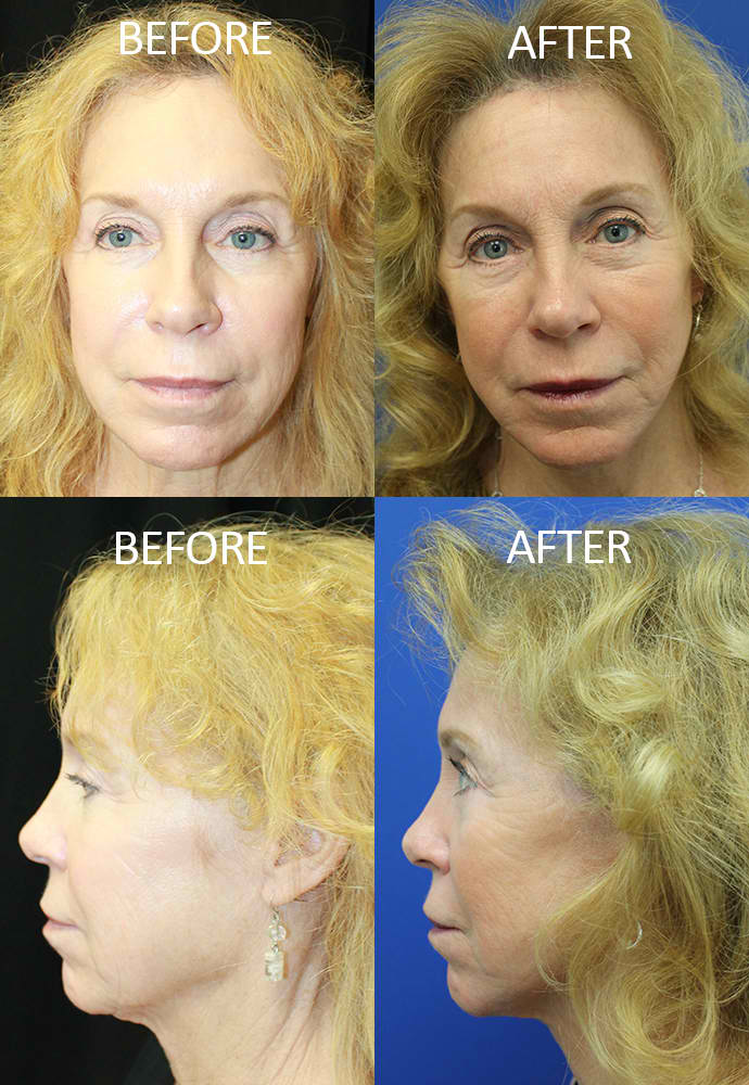 Face & Neck Lift